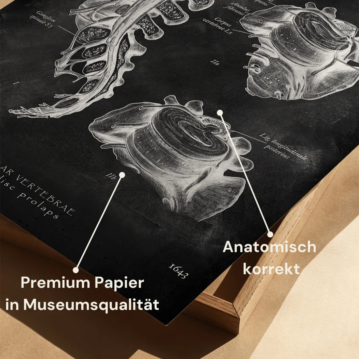 Bandscheibenvorfall Anatomie - Chalkboard - Animus Medicus GmbH