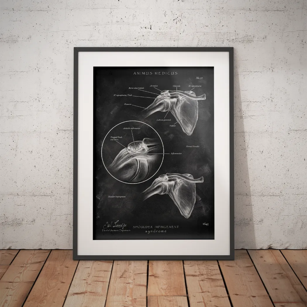 Schulter Impingement - Chalkboard - Animus Medicus GmbH