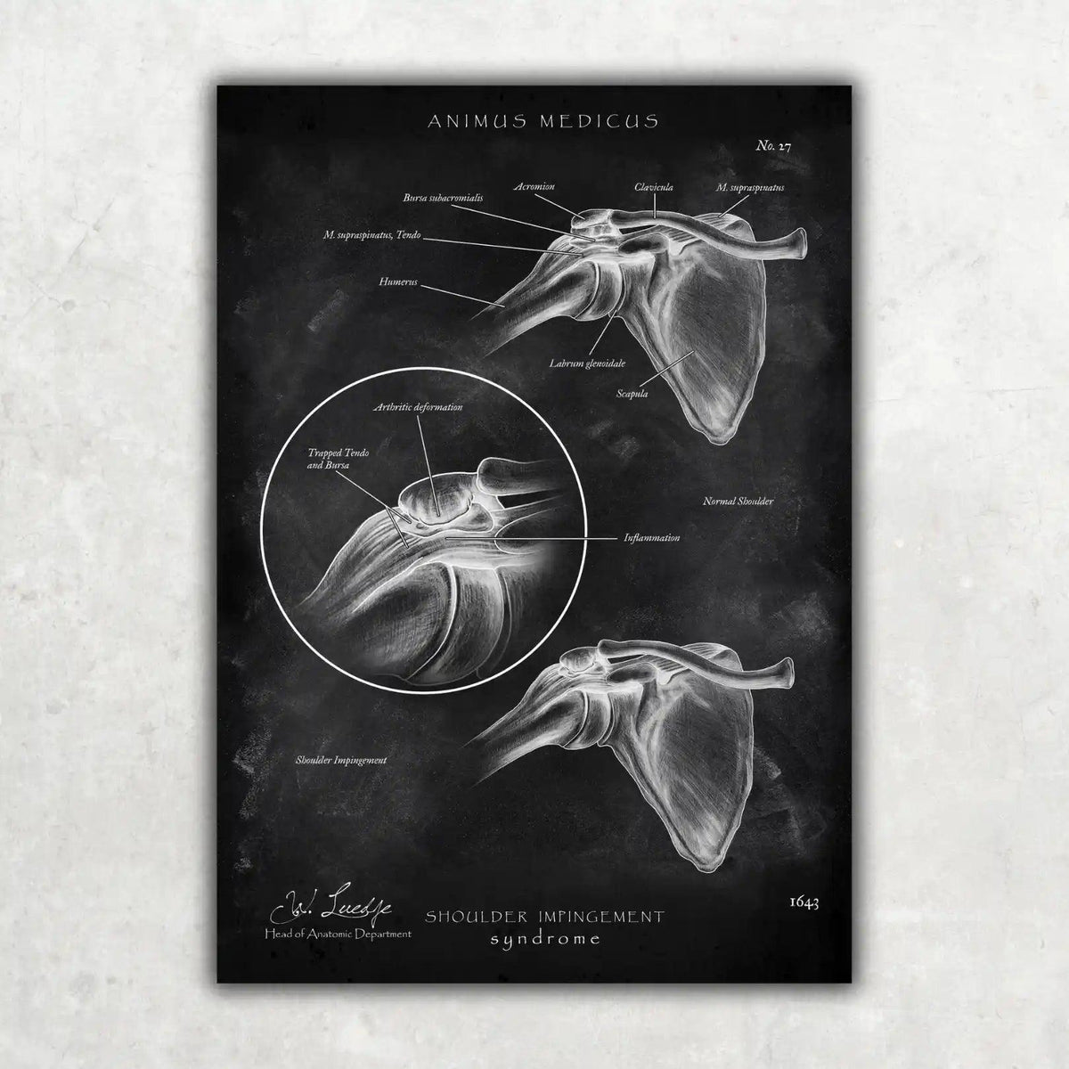 Schulter Impingement - Chalkboard - Animus Medicus GmbH