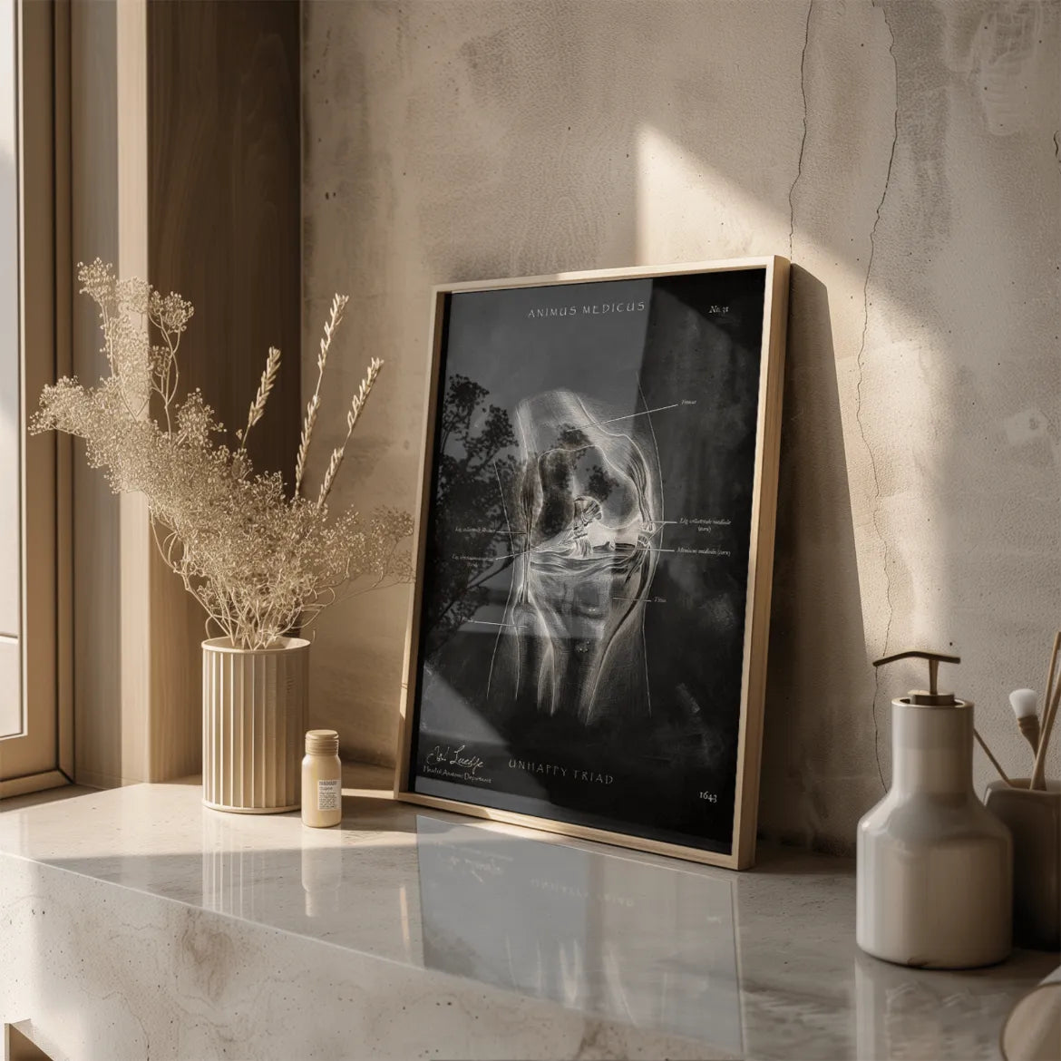 Unhappy Triad Knie - Chalkboard - Animus Medicus GmbH