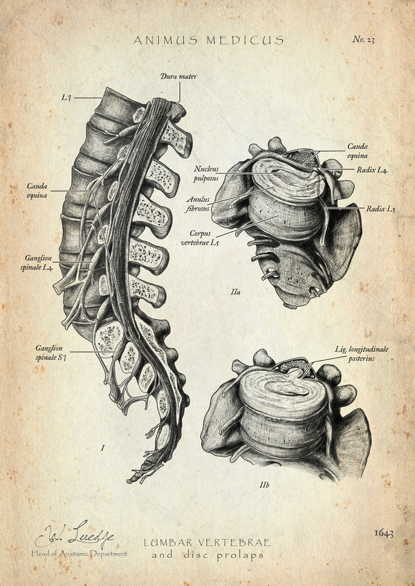 Bandscheibenvorfall Anatomie Poster