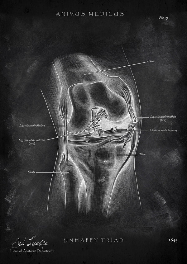 Unhappy Triad Knie - Chalkboard