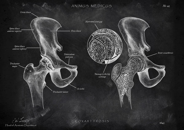 Hüftarthrose - Chalkboard