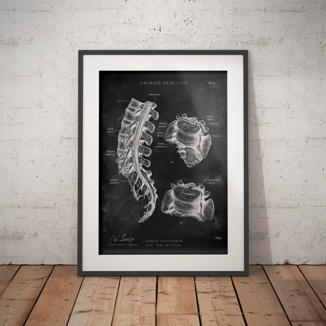 Bandscheibenvorfall Anatomie - Chalkboard - Animus Medicus GmbH